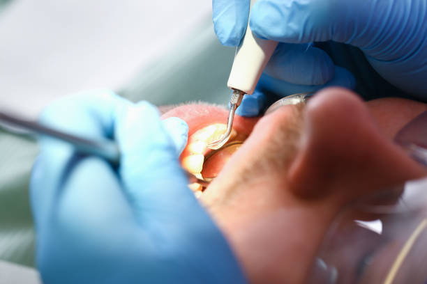 Best Emergency Tooth Extraction in Cambridge, IL